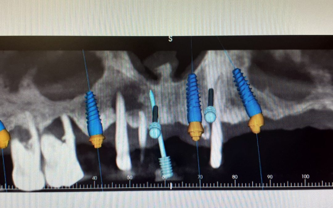 Implantologia Computer Guidata: denti fissi senza tagli e senza punti.
